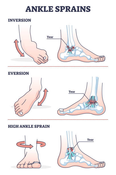 Ankle sprains situations with inversion and eversion injury outline diagram Ankle sprains situations with inversion and eversion injury outline diagram. Twisted foot or leg pain and swollen inflammation cause with bone and ligament xray medical explanation vector illustration ankle stock illustrations