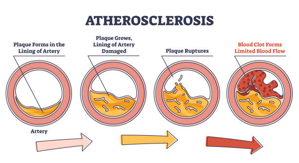 Atherosclerosis stages explanation and fatty plaque formation outline diagram Atherosclerosis stages explanation and fatty plaque formation outline diagram. Artery side view with limited blood flow and rupture risk vector illustration. Dangerous health condition explanation. atherosclerosis stock illustrations