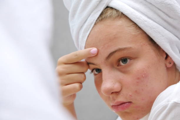 A sad teenage girl is looking at the pimples on her face in the mirror. Problematic skin. Acne. A sad teenage girl is looking at the pimples on her face in the mirror. Acne. Problematic skin in adolescents. acne stock pictures, royalty-free photos & images