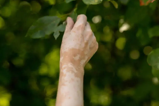 Photo of Hand skin pigmentation. White-brown leather. Melasma. Benign pigmentation. Hormonal Disorders. Medical concept.
