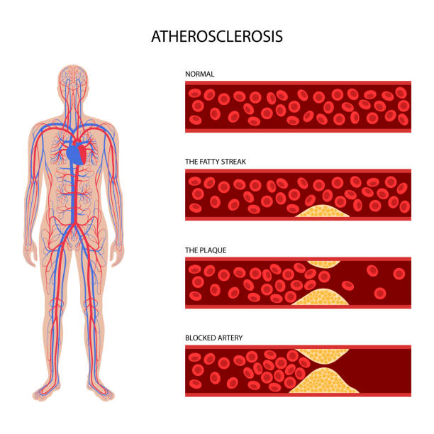 Cholesterol and atherosclerosis Cholesterol in human blood vessels. Arteriosclerosis and artery system in man silhouette. Fat cells in vein. High ldl and hdl level. Blocked vascular. Human body medical poster vector illustration clogged artery stock illustrations