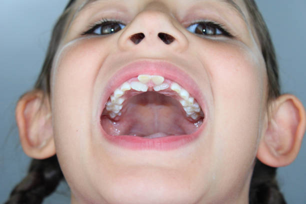 istock Seven year old girl with shark teeth 1331444744