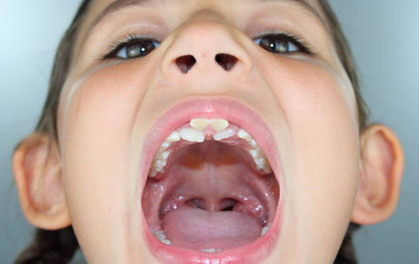 istock Seven year old girl with shark teeth 1331444756