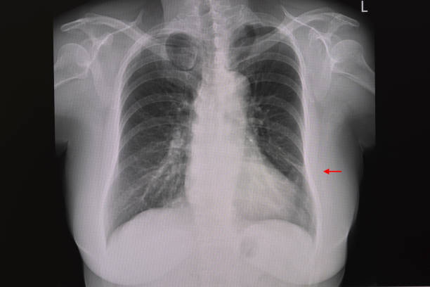 una radiografia toracica di un paziente che mostra una piccola atelettasi della piastra nel polmone sinistro. - thoracic cavity foto e immagini stock