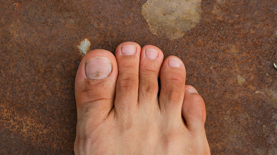 Male Foot with second toe longer than a big toe. Mortons's toe, Greek foot or Royal toe or Aboriginal feet.
