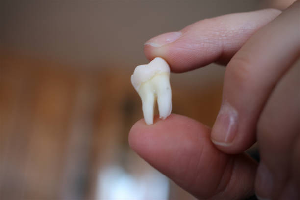 istock Large healthy white tooth extracted from mouth 1331673366