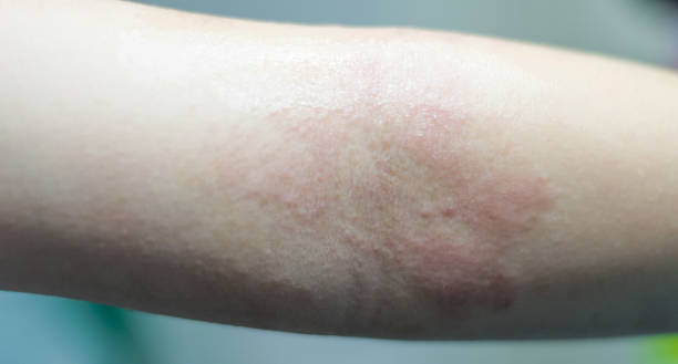 eczema atopic dermatitis symptom with infected skin on child foldable joint arm. Wound from insect bite or fungus or bacteria or virus eczema atopic dermatitis symptom with infected skin on child foldable joint arm. Wound from insect bite or fungus or bacteria or virus leprosy stock pictures, royalty-free photos & images