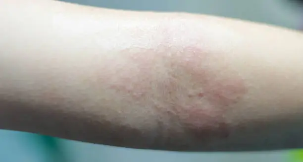 Photo of eczema atopic dermatitis symptom with infected skin on child foldable joint arm. Wound from insect bite or fungus or bacteria or virus