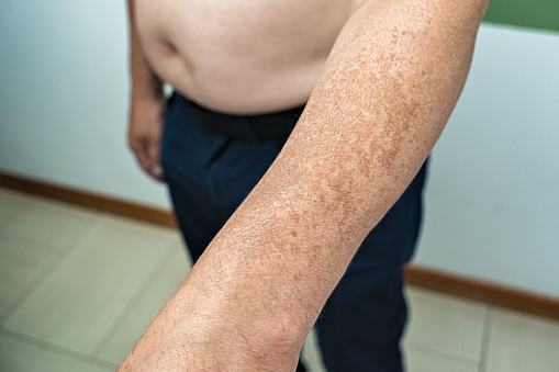 Male patient with dermatitis caused by sun exposition