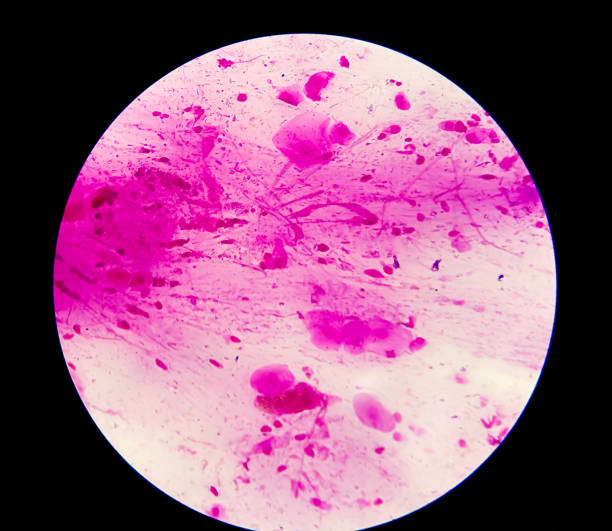 tampone avvolto o pus gram macchia microscopica 100x obiettivo mostrano gram positive diplococci, canne gram negative e fungus candida albican presso laboratorio di microbiologia medica. - bacterium staphylococcus colony epidemic foto e immagini stock