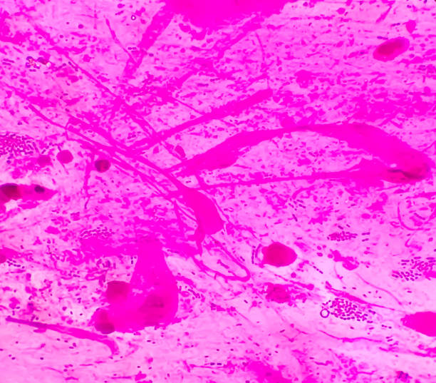 swab de ferida ou pus gram mancha microscópica 100x objetivo mostrar gram diplococci positivo, varas gram negativas e fungos candida albican no laboratório de microbiologia médica. - bacterium colony laboratory pus - fotografias e filmes do acervo