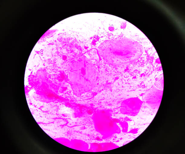 상처 면봉 또는 고름 그람 얼룩 현미경 100x 목표 쇼 그램 긍정적 디플로코치, 그램 네거티브 로드와 의료 미생물학 실험실에서 곰팡이 칸디다 알비칸. - bacterium staphylococcus colony epidemic 뉴스 사진 이미지