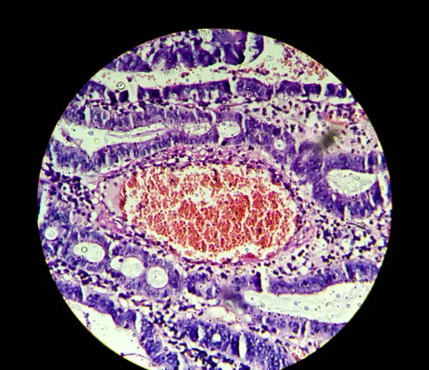 Photo of Colon Cancer. Photomicrograph (microscopic image) of colonic adenocarcinoma,Light microscope 100x showing colon adenocarcinoma