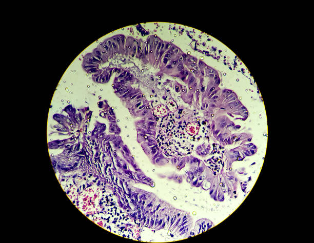 istock Ovarian cancer, Micrograph of adenocarcinoma 1331869592