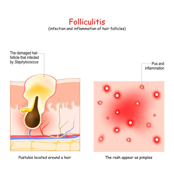 Folliculitis Stock Photos, Pictures & Royalty-Free Images - iStock