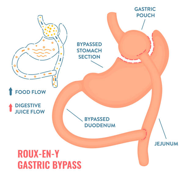 Roux-en-y gastric bypass bariatric surgery weight loss infographics Roux-en-y gastric bypass. Bariatric surgery weight loss procedure. Stomach reduction anatomical diagram infographic. Health care medical concept. Vector illustration. jejunum stock illustrations
