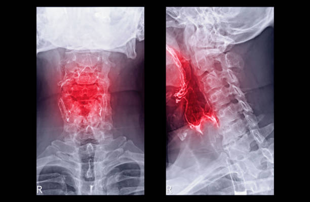 ösophagramm oder barium schlucken ap und laterale ansicht zeigt speiseröhre für die diagnose gerd oder gastroösophageale refluxkrankheit und speiseröhrenkrebs. - barium stock-fotos und bilder