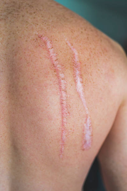 Man with a scars Back of a caucasian man with a scars scarification stock pictures, royalty-free photos & images