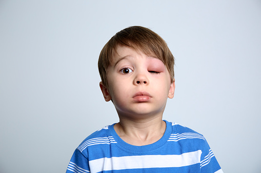 A boy with swollen eye from insect bite. Quincke edema. Portrait of Caucasian appearance child looking at the camera. Studio background. Isolated. Face of allergic person. Copy space. Studio. Allergy.