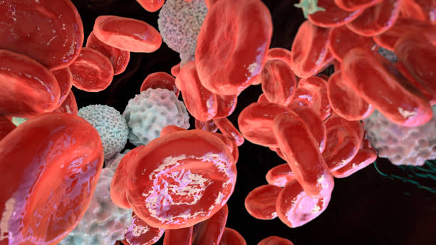 Polycythemia, an increase in the number of red blood cells in the body stock photo