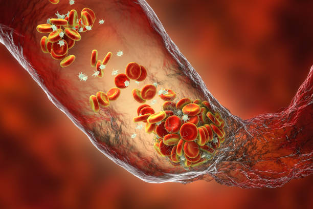 caillot sanguin composé de globules rouges, de plaquettes et de brins de protéines de fibrine. thrombus - thrombose photos et images de collection