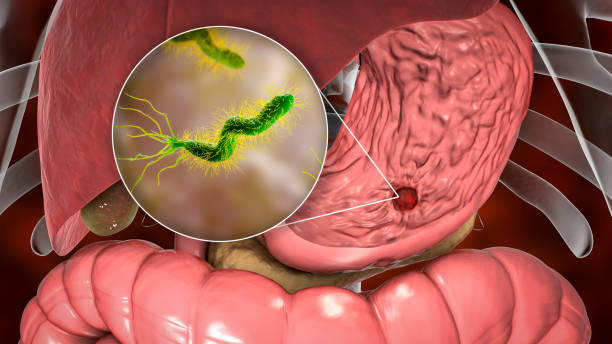 Peptic ulcer, stomach ulcer stock photo
