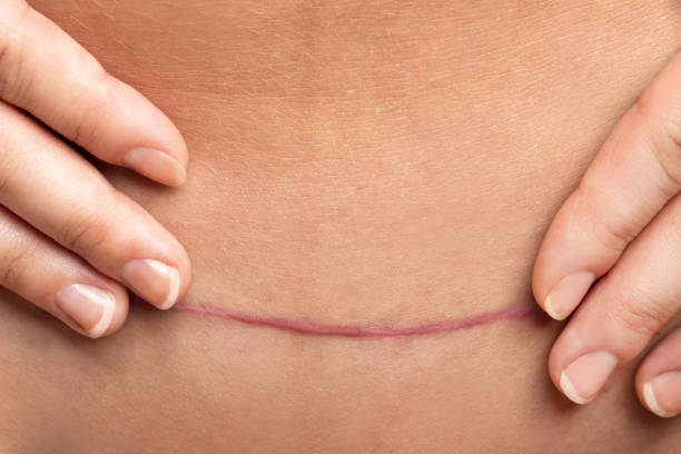 narbe nach kaiserschnittoperation am weiblichen bauch - scar stock-fotos und bilder