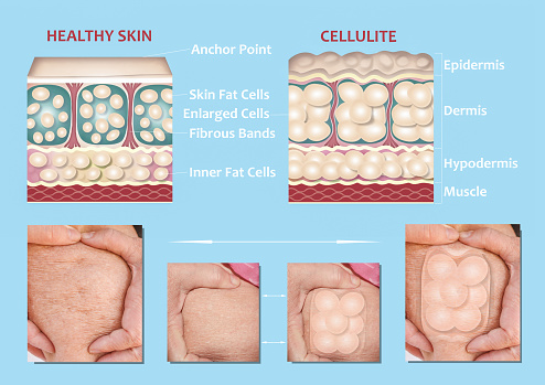 Forming of underskin cellulite illustration. Structure of normal healthy and cellulite skin. Comparison