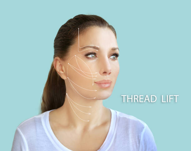 istock thread lift procedure ,non-surgical facelift,markup 1332190729