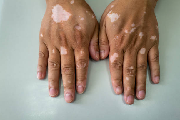 vitiligo de mão - vitiligo fotos em fotos