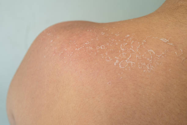 istock Skin peeling after sunburn 1332262944
