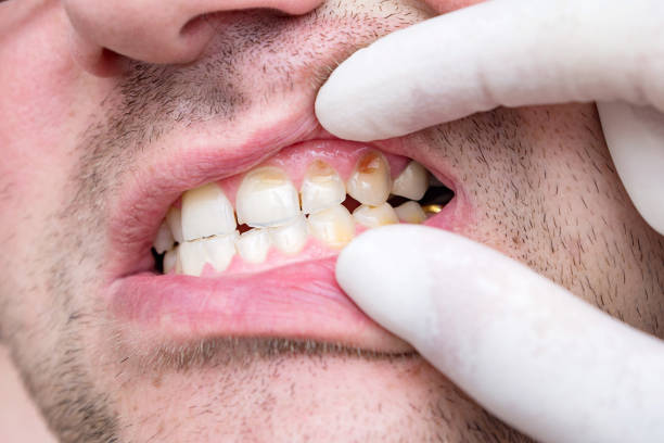Bad teeth of a middle-aged man. Chipped and cracked tooth enamel, enamel hypoplasia, malocclusion and dental crowns. Negligent attitude towards your health, concept. stock photo