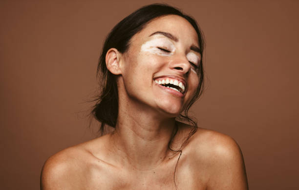 Happy woman with skin condition Portrait of a smiling young woman with vitiligo. Close up of woman with skin disorder smiling with eyes closed against brown background. semi dress stock pictures, royalty-free photos & images
