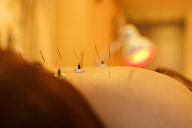 Body acupuncture and Moxibustion as Alternative Medicine Closeup to Body acupuncture and Moxibustion for the human back acupuncture model stock pictures, royalty-free photos & images