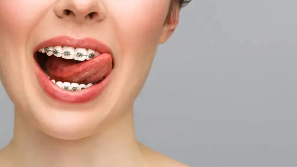 Orthodontic treatment. Closeup ceramic and metal brackets on teeth. Female smile with braces. Dental care concept