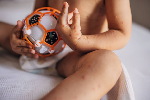 Baby boy with with hand foot and mouth disease Little boy with with hand foot and mouth disease sitting on bed and playing with ball. hand foot and mouth disease stock pictures, royalty-free photos & images