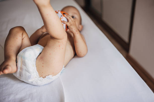 Baby boy with with hand foot and mouth disease Little boy with with hand foot and mouth disease lying on bed and playing with ball. hand foot and mouth disease stock pictures, royalty-free photos & images