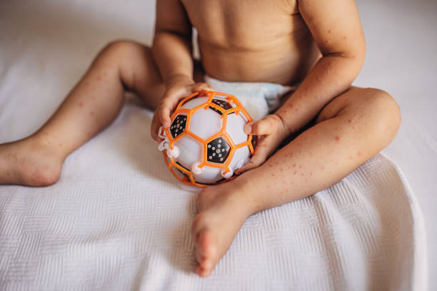 Baby boy with with hand foot and mouth disease Little boy with with hand foot and mouth disease sitting on bed and playing with ball. hand foot and mouth disease stock pictures, royalty-free photos & images