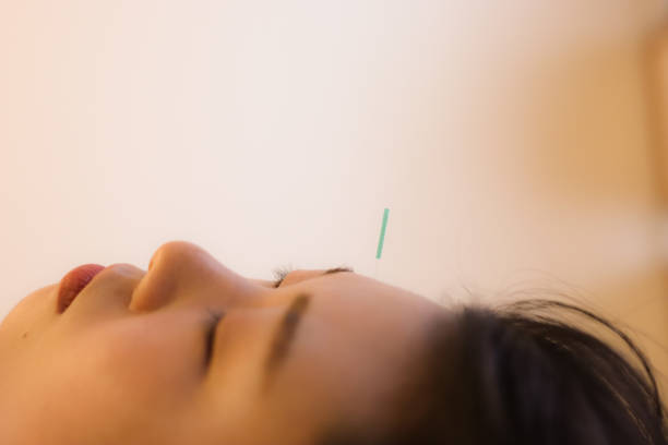 agopuntura cosmetica facciale per donna in asia - acupuncture spa treatment asian culture medicine foto e immagini stock