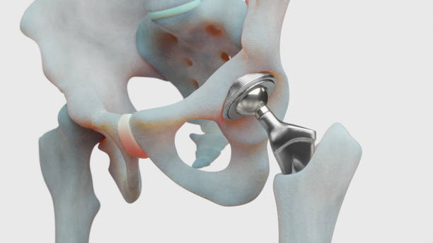 Hip implant 3D rendering of a human hip implant with realistic-looking bones hip replacement stock pictures, royalty-free photos & images