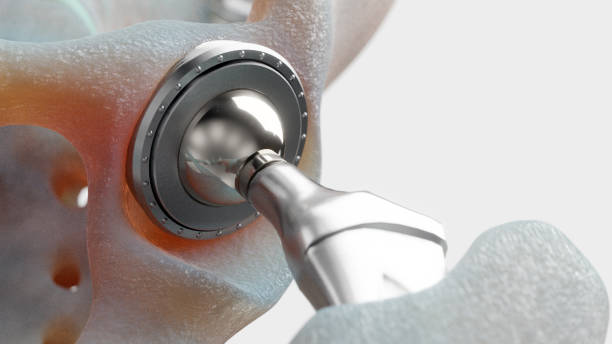 Details of hip implant device 3D rendering of hip implant detail in realistic-looking bones hip replacement stock pictures, royalty-free photos & images