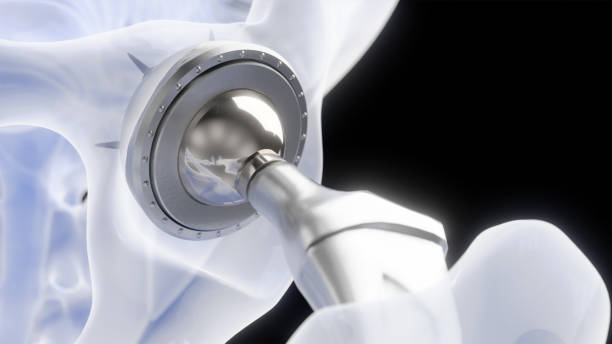 Hip implant detail X-ray 3D rendering of hip implant detail in x-ray stylized bones hip replacement stock pictures, royalty-free photos & images