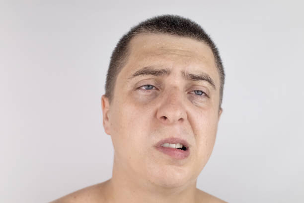 istock A man with sweating on his face is looking at the camera. Sweat gland problems. Hyperhidrosis, increased sweating, anhidrosis. The concept of treatment for violations of the mechanisms of secretion. 1332521916