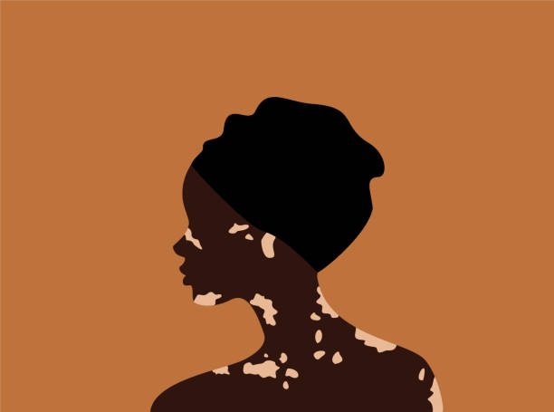 Side view of african woman in turban with vitiligo on an orange background. Body positive concept. Flat vector illustration Side view of african woman in turban with vitiligo on an orange background. Body positive concept. Flat vector illustration vitiligo stock illustrations