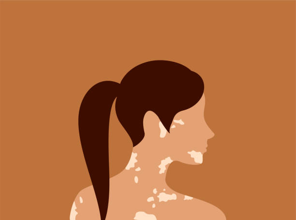 Side view of brown-haired aucasian woman with vitiligo on an orange background. Body positive concept. Flat vector illustration Side view of brown-haired aucasian woman with vitiligo on an orange background. Body positive concept. Flat vector illustration vitiligo stock illustrations