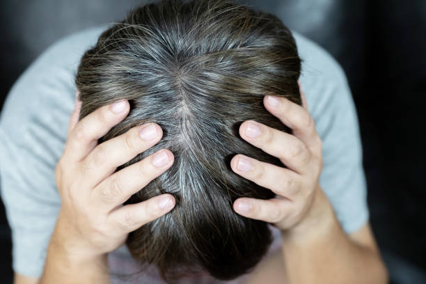 istock A man has hair growth, he has hair loss problems. Dry scalp, dandruff 1332613614
