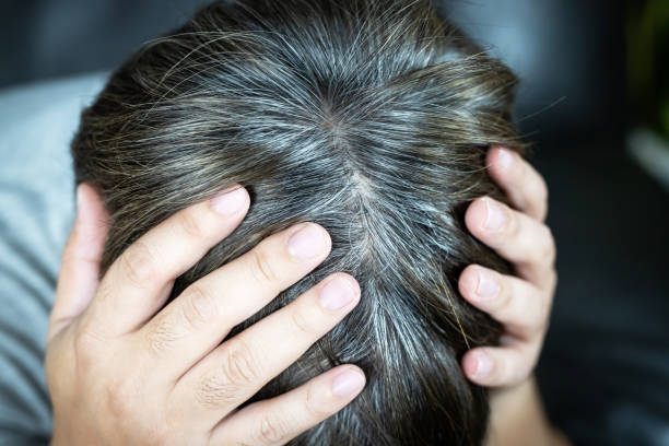 istock A man has hair growth, he has hair loss problems. Dry scalp, dandruff 1332613636