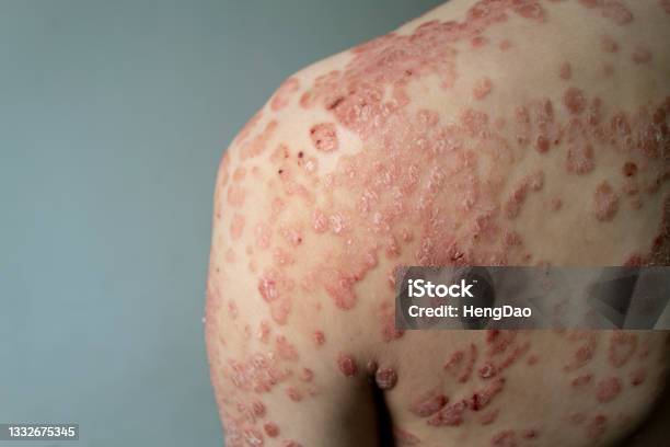 Psoriasis Stock Photo - Download Image Now - Psoriasis, Human Skin, Irritation