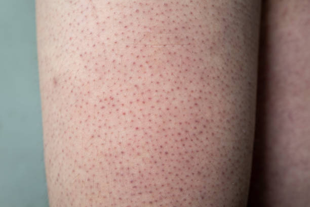 Keratosis pilaris