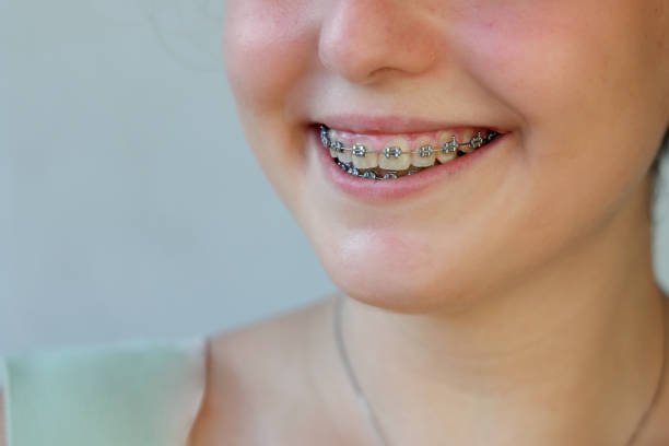 istock Young woman with brackets on teeth 1332814507